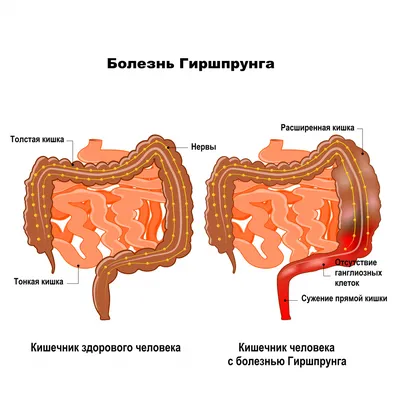 Робот-ассистированная резекция тонкой кишки ▷ Лечение в Днепре ⋮ MEDICAL  PLAZA