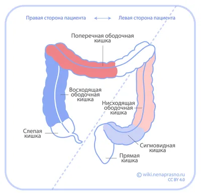 Резекция толстой кишки (желудка)