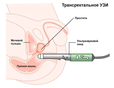 Язва желудка и двенадцатиперстной кишки. Лечение.