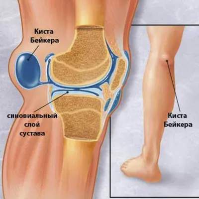Киста Бейкера коленного сустава Лечение Без операции в Киеве