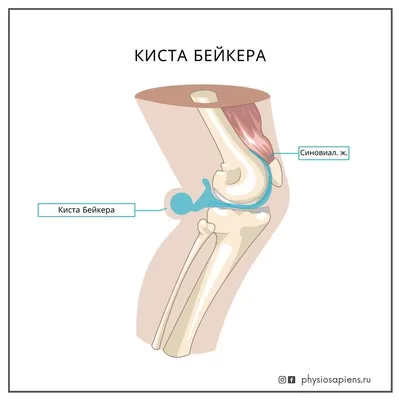 ultrazvuk - ⚠️Киста Бейкера⚠️ или киста подколенной ямки - это мягкое  плотное эластичное опухолевидное образование, которое располагается на  задней поверхности коленного сустава, т.е. в подколенной ямке.  💡ДИАГНОСТИКА:УЗИ коленных суставов ...