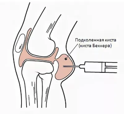 Удаление кисты Бейкера