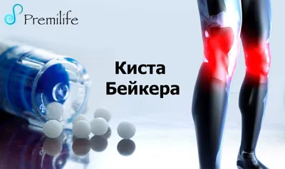 КИСТА БЕЙКЕРА | PhysioSapiens.ru | Дзен