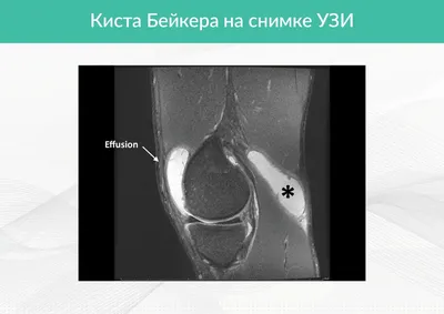 Последствия кисты Бейкера: осложнения и последствия без лечения