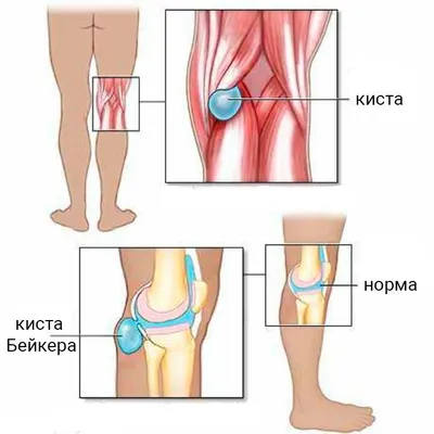 Киста Бейкера у детей | Герммед