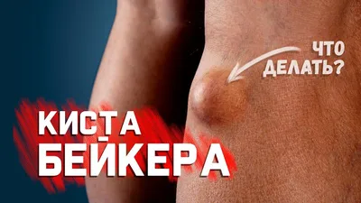 Киста Бейкера: как не довести до разрыва? | Медицинский центр Е.В.  Малышевой | Дзен