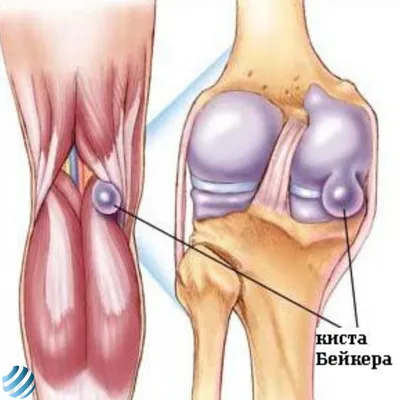 МРТ Лидер Благовещенск - Киста Бейкера (Беккера, подколенная киста) – это  результат воспалительного процесса слизистых межсухожильных сумок между  сухожилиями средней головки икроножной и полуперепончатой мышц. Такие  межсухожильные слизистые сумки ...