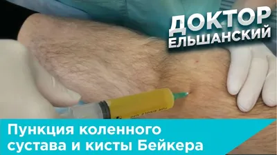 Киста Бейкера: как не довести до разрыва? | Медицинский центр Е.В.  Малышевой | Дзен