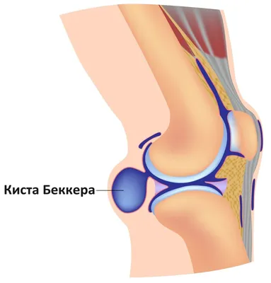 Киста Бейкера — 24Radiology.ru