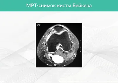 ГКБ №31 им. академика Г.М. Савельевой - Лечение и удаление кисты бейкера в  Москве