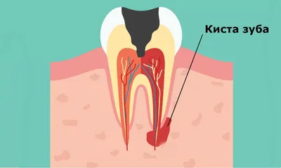 Киста после удаления зуба: кто виноват и как лечить заболевание | Dental Art