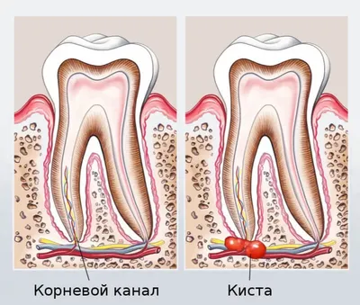 Хирургическое удаление кисты, гранулемы зуба, операция цистэктомия с  резекцией верхушки корня