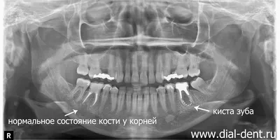 Удаление кисты зуба – показания, методы операции, можно ли вылечить без  удаления