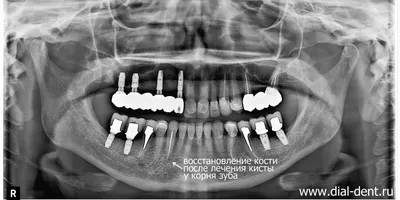 Эпулис, киста прорезывания (Москва) - Профессиональный стоматологический  портал (сайт) «Клуб стоматологов»