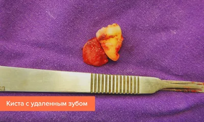 Эндодонтическое лечение кист и гранулём зуба | medicaldent.by