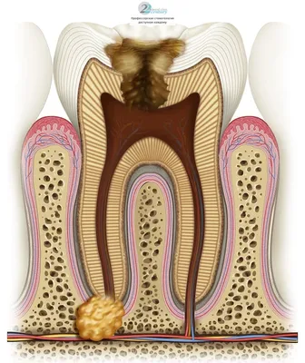 Лечение кисты и гранулемы зуба | Videdent.ru