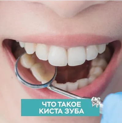 Лечение кисты зуба. Москва. | DENTALROOM