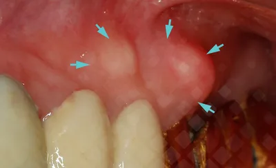 Киста на десне: фото, лечение, симптомы