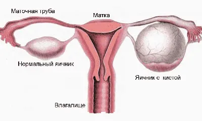 Киста яичника лечение, операция по удалению кисты яичника полостная,  лапароскопия кисты цена