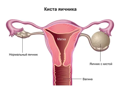 Киста яичника: симптомы, причины, виды, что делать, чем опасна, как  избавиться