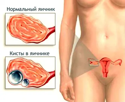 Киста яичника - Многопрофильный медицинский центр \"СитиМед\" в  Санкт-Петербурге