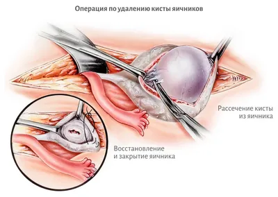 Киста яичника — как обнаружить и вылечить