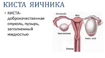 Лапароскопия кисты яичника в Харькове ✳️ Хирургия ОМИХ