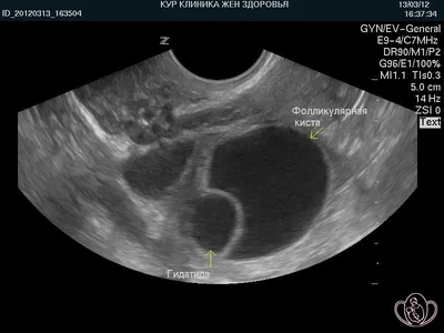 Кисты яичников / Болезни / Лапароскопия в Воронеже