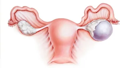ve_gazhonova - КИСТА ЯИЧНИКА - оперировать или подождать?... | Facebook