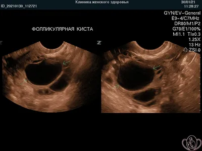 Как выглядит киста яичника? УЗИ и МРТ в диагностике разных видов кист