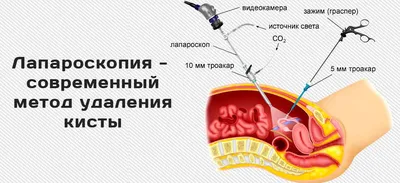 Киста яичника. Лечение кисты яичников в Ташкенте в клинике Urologic Complex