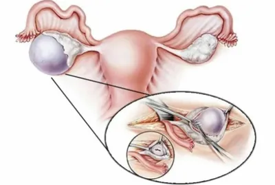 Дермоидная киста яичника – причины, симптомы, диагностика и лечение в  клинике «Будь Здоров»