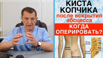 КИСТА КОПЧИКА - Когда нужно ОПЕРИРОВАТЬ КИСТУ КОПЧИКА после вскрытия его  абсцесса? - YouTube