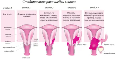 Киста копчика (эпителиальный копчиковый ход) | Цена операции в Украине