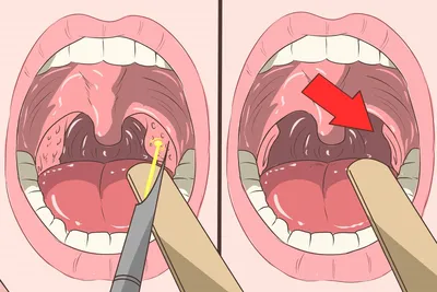 Киста на миндалине в горле (ФОТО): чем опасна киста на гландах и что делать