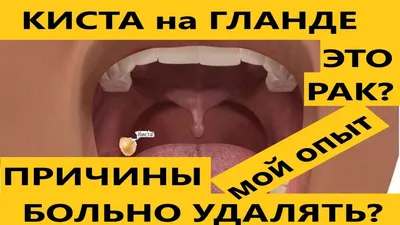 Гнойная киста миндалины - Советчица