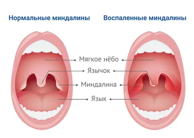 Киста на миндалине, причины, последствия, как удаляли? - YouTube