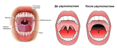 Арахноидальная киста головного мозга чем опасна