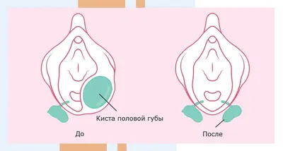 Киста половой губы: причины, симптомы, диагностика, лечение, операция в  клинике «АльтраВита»