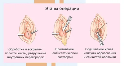 Марсупиализация кисты бартолиновой железы: цены в Москве | АльтраВита