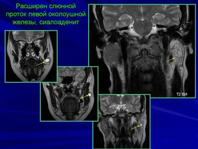 Гранулы фордайса на губах, фото до и после, удаление в клинике Medicris