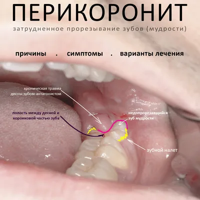 Адентия – причины, диагностика, лечение, профилактика