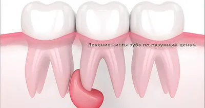 Киста челюсти - виды, причины, симптомы, признаки, диагностика, лечение  (операция по удалению)