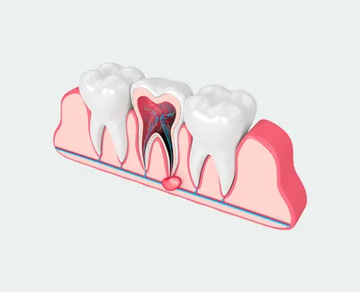 Удаление кисты зуба по доступной цене - клиника Центрстом на Бауманской,  Москва