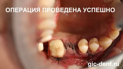 Дермоидная киста корня языка - DENTALMAGAZINE.RU