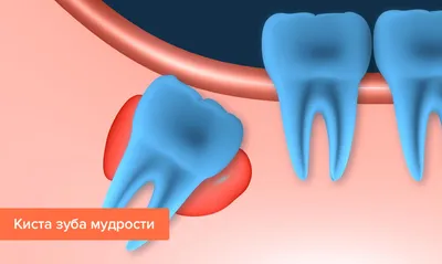 Удаление кисты малой слюнной железы. Как это делается? | Пикабу