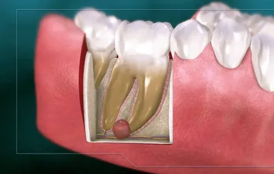 Киста зуба, обнаруженная на компьютерной томограмме зубов