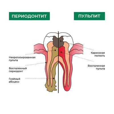 Кисты челюстей у детей