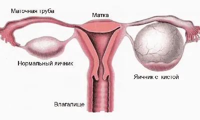 Месячные при кисте яичника: почему возникает задержка и скудные месячные,  может ли киста выйти во время менструации, диагностика и лечение