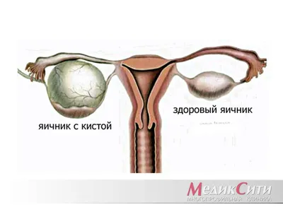 Задержка месячных при кисте яичника. Лечение кисты яичника в Москве